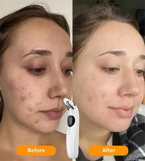 BlaRevia Blackhead Removers