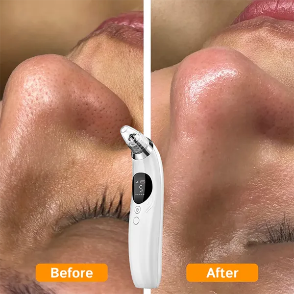 BlaRevia Blackhead Removers